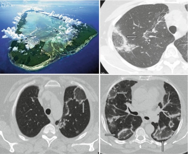 Fibrosis and Salt and Pepper Sign Radiology Key