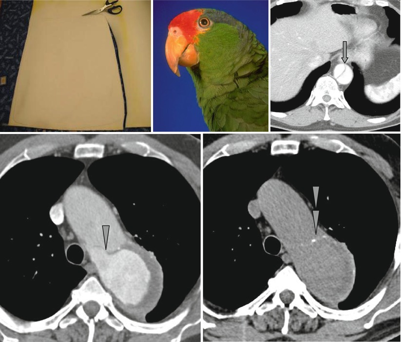 Flap and Beak Sign | Radiology Key