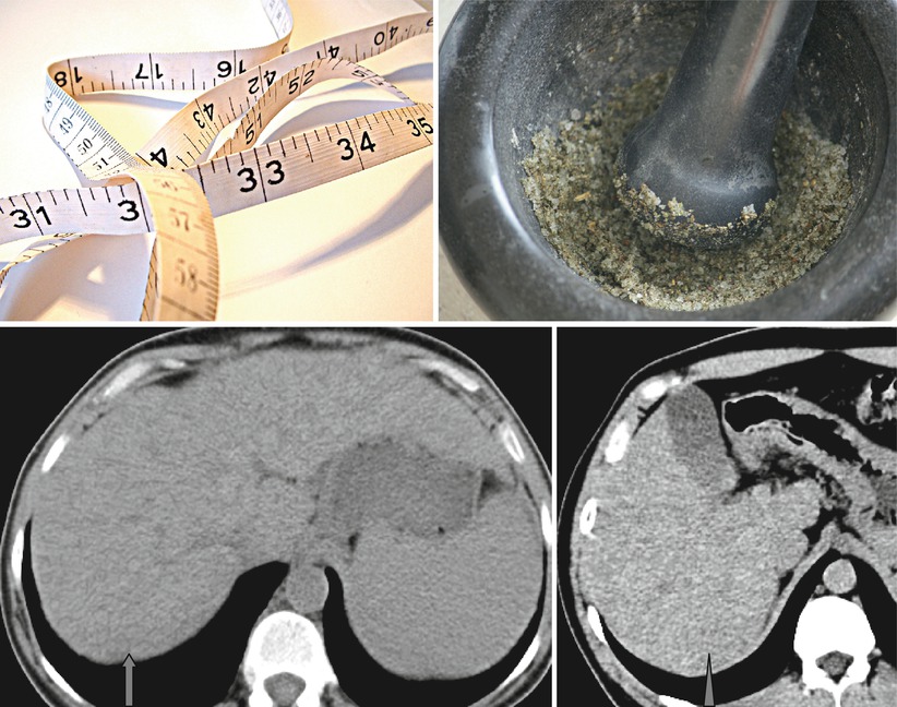 Fibrosis and Salt and Pepper Sign Radiology Key