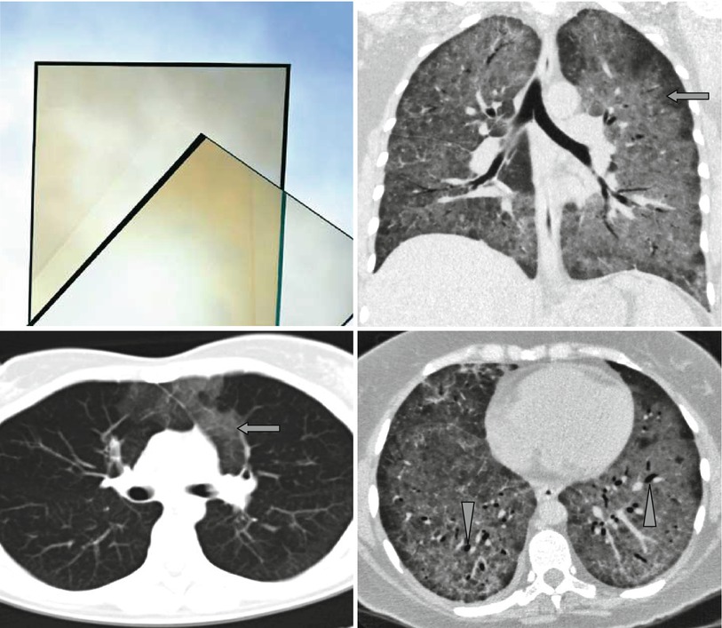 Opacity and Black Bronchus Sign | Radiology Key