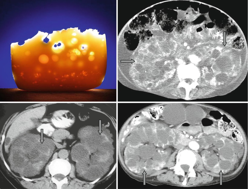 Cheese Sign | Radiology Key