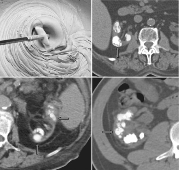 Cheese Sign Radiology Key