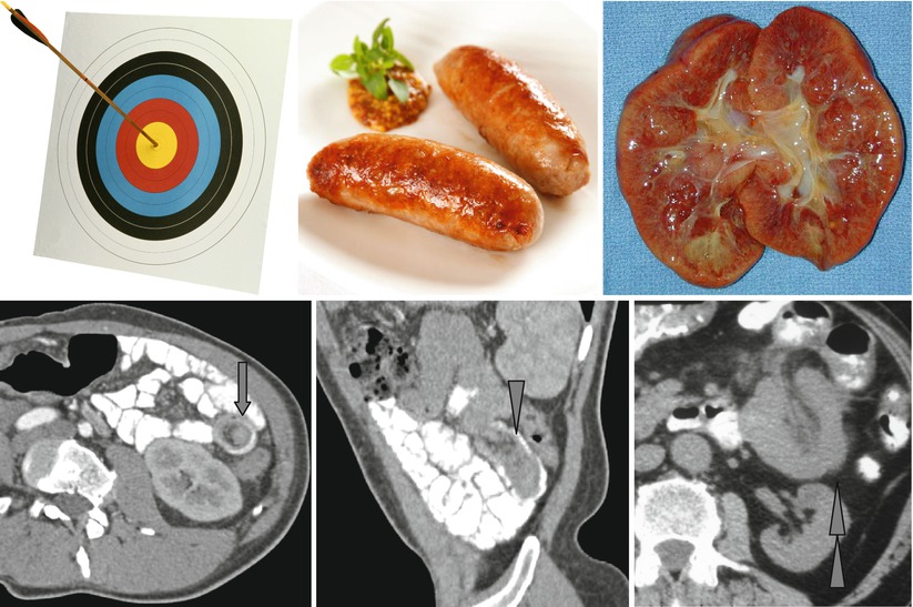 Sign, SausageShaped Mass, and Reniform or KidneyShaped Bowel