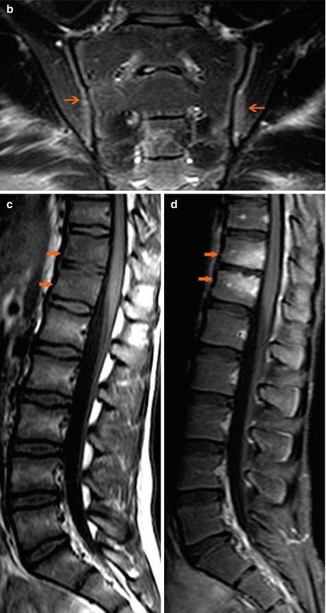 Undifferentiated Spondyloarthritis | Radiology Key