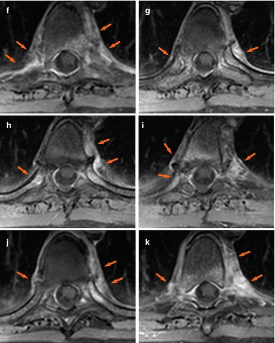 Psoriatic Arthritis Radiology Key