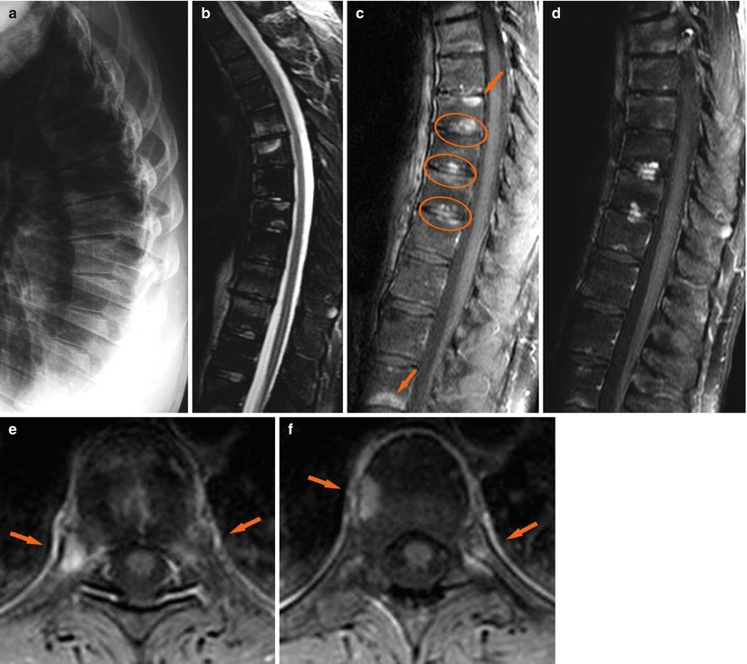 Ankylosing Spondylitis | Radiology Key