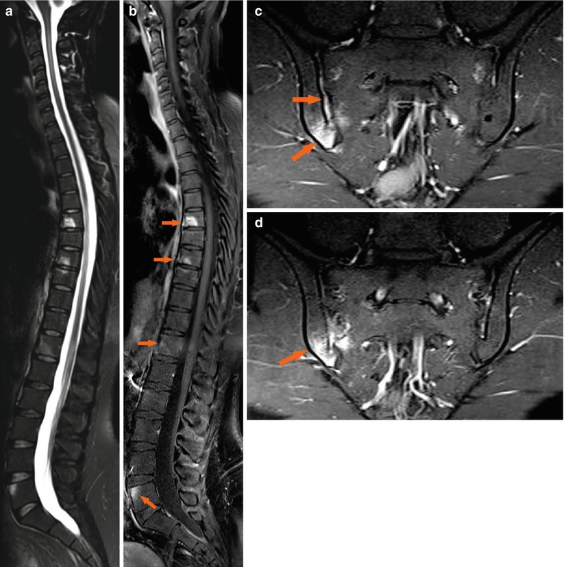 Psoriatic Arthritis | Radiology Key