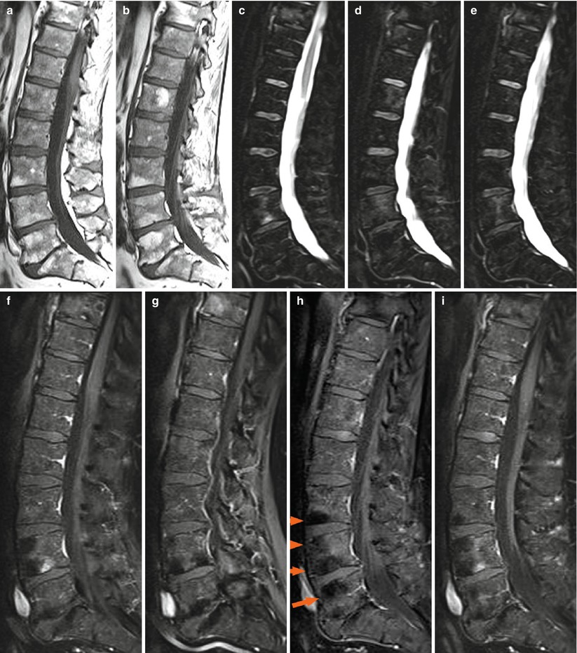 Ankylosing Spondylitis Fusion