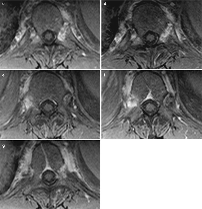 Psoriatic Arthritis Radiology Key