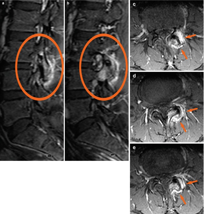 Psoriatic Arthritis Radiology Key