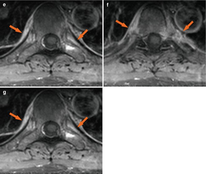 Psoriatic Arthritis Radiology Key