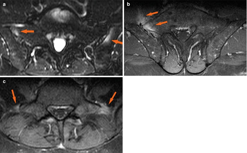 Psoriatic Arthritis | Radiology Key