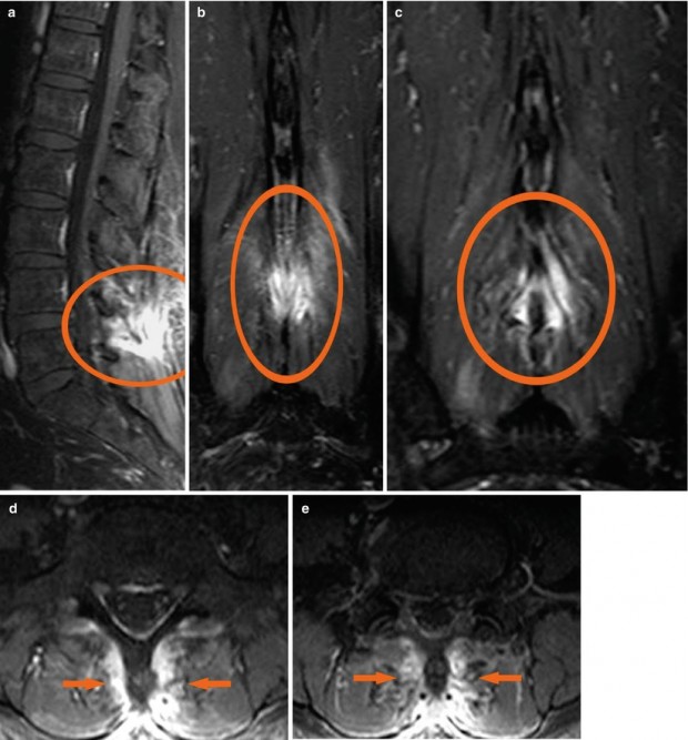 Psoriatic Arthritis Radiology Key