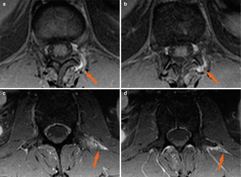 Ankylosing Spondylitis | Radiology Key