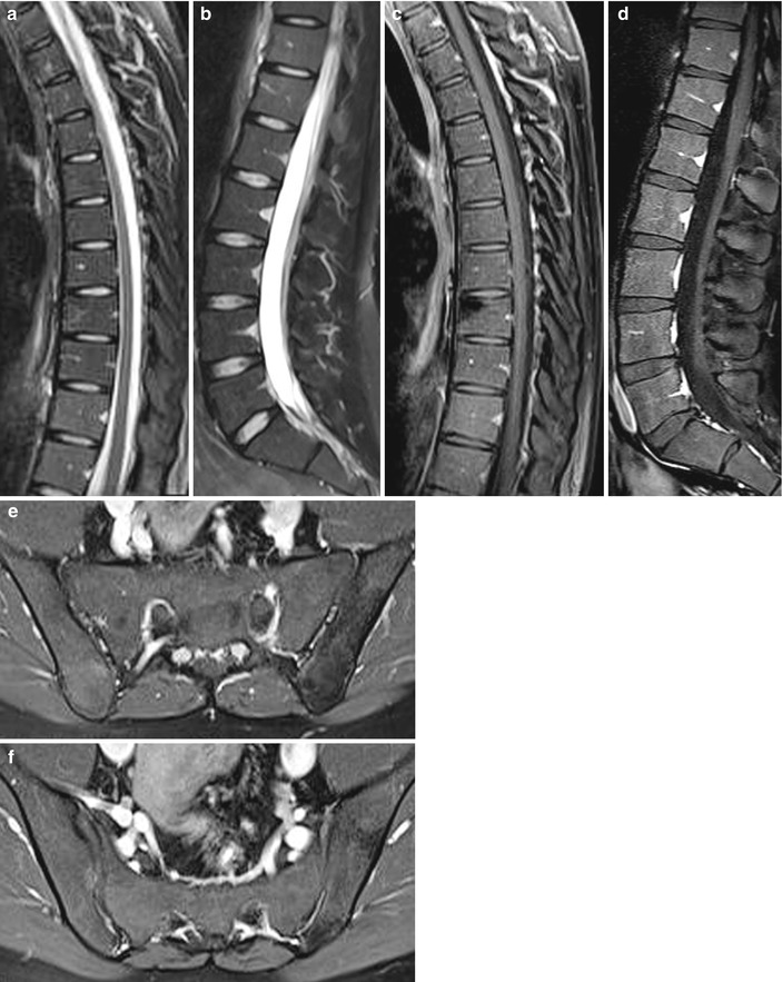 Psoriatic Arthritis Radiology Key