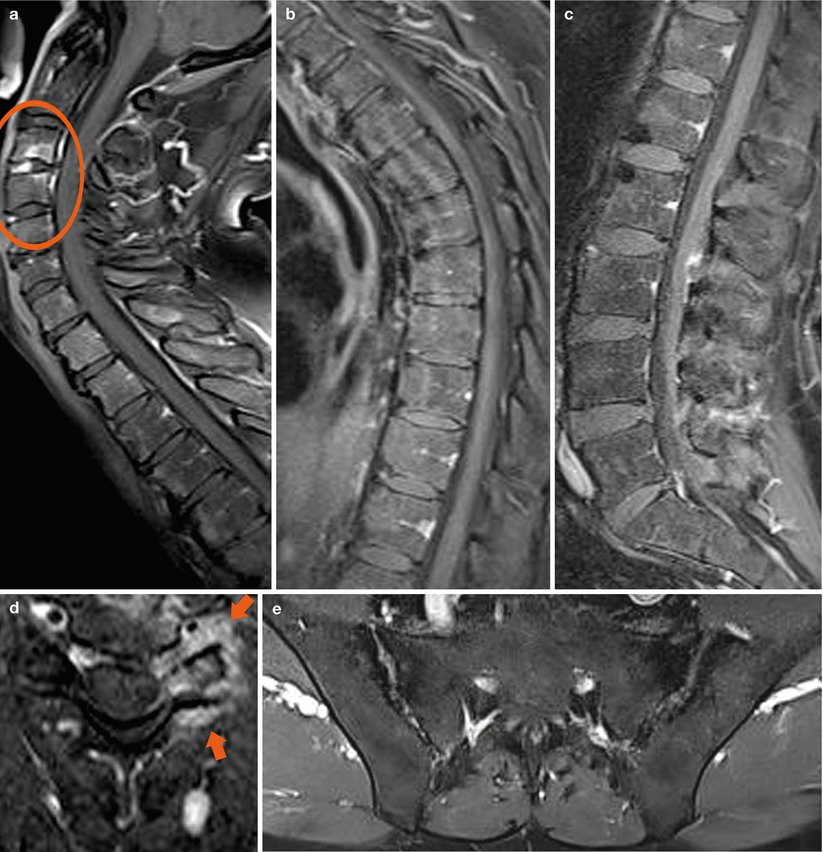 Ankylosing Spondylitis Radiology Key 1120