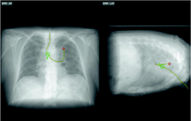 Image Guided Bronchoscopy Radiology Key