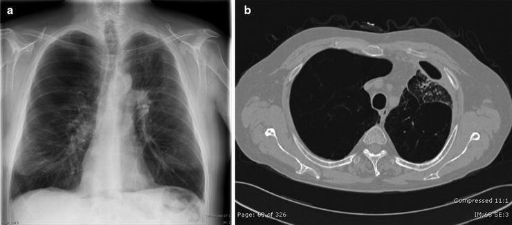 Endoscopic Lung Abscess Drainage 