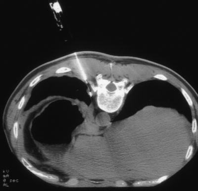 Pleural Imaging | Radiology Key