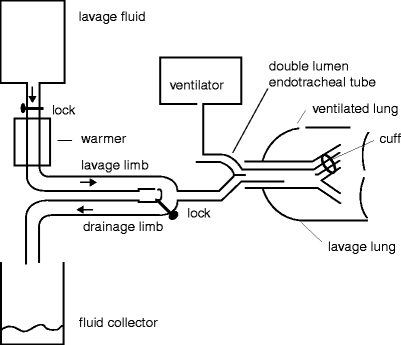 Rigid Bronchoscopy | Radiology Key