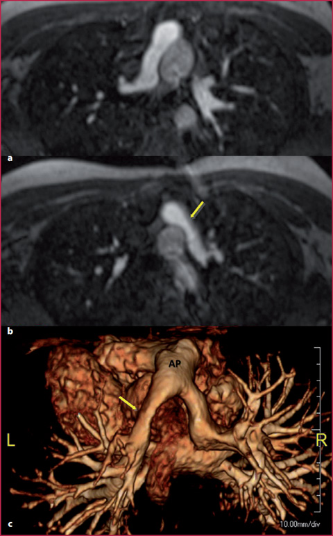 Pulmonary Circulation | Radiology Key