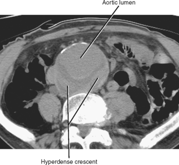 Imaging Evaluation Of Acute Abdominal Pain | Radiology Key