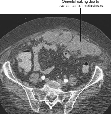 Omental cakes: unusual aetiologies and CT appearances | Insights into  Imaging | Full Text