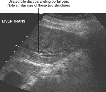 common hepatic duct ultrasound