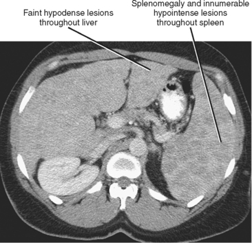 Spleen | Radiology Key