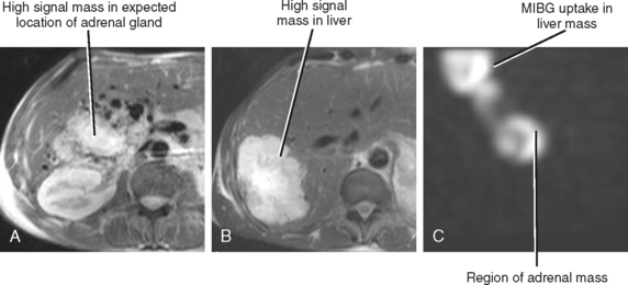 Adrenal Glands Radiology Key