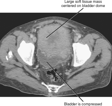 Ureters, Bladder, and Urethra | Radiology Key