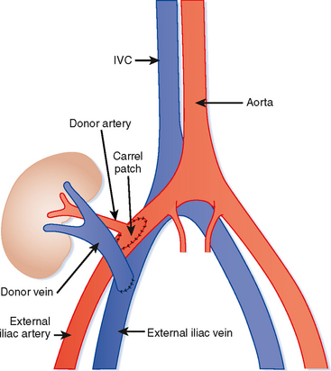 Female Ureter Anatomy