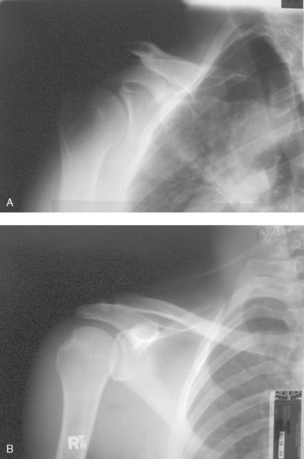 Pectoral girdle, Radiology Reference Article