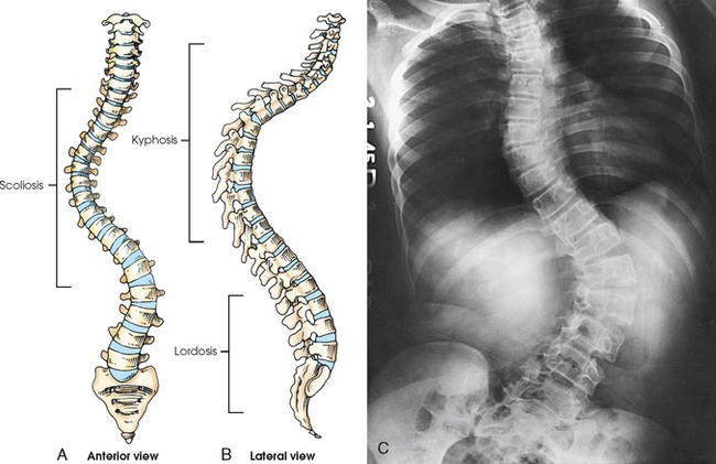 Normal lateral view of the lumbar vertebrae showing spinal