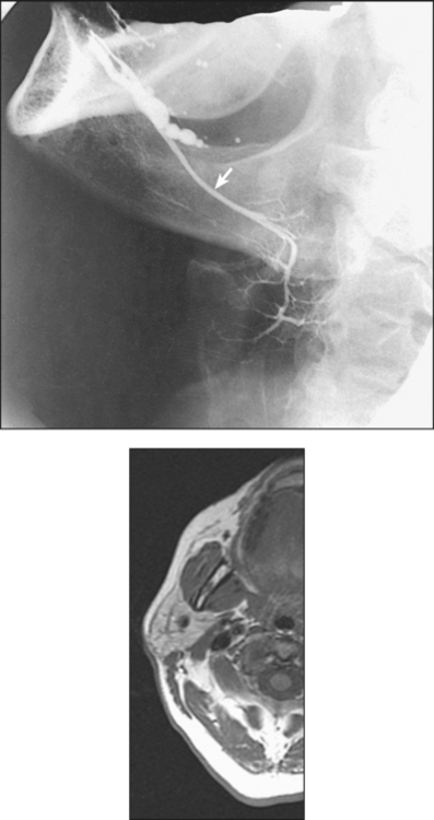 MOUTH AND SALIVARY GLANDS | Radiology Key