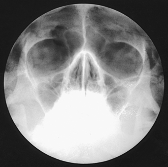 Paranasal Sinuses Radiology Key