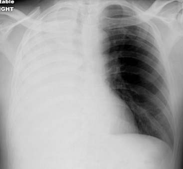 Recognizing The Causes Of An Opacified Hemithorax Radiology Key