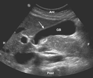 Gallbladder Anatomy Ultrasound