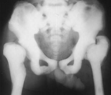 bone density abnormalities recognizing osteopetrosis disease marble figure