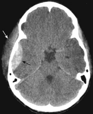 Recognizing Some Common Causes of Intracranial Pathology | Radiology Key