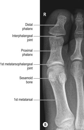 Foot, toes, ankle, tibia and fibula | Radiology Key