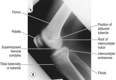 Knee and femur | Radiology Key