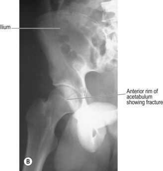 Pelvis and hips | Radiology Key