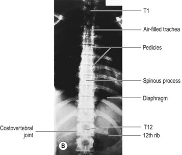 Thoracic spine | Radiology Key
