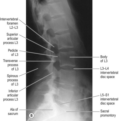 Lumbar spine | Radiology Key