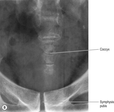 The Sacrum And The Coccyx A Cautionary Tale Sacroilia - vrogue.co