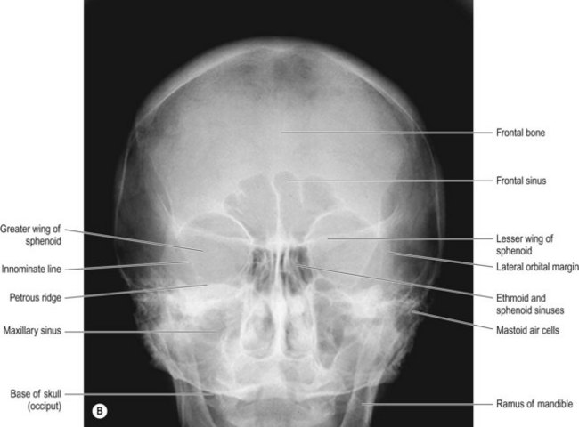 Cranial vault | Radiology Key