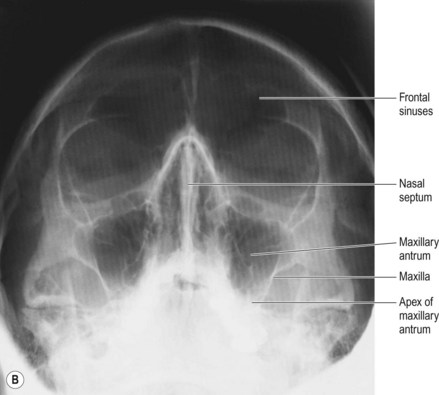 Paranasal Sinuses Radiology Key