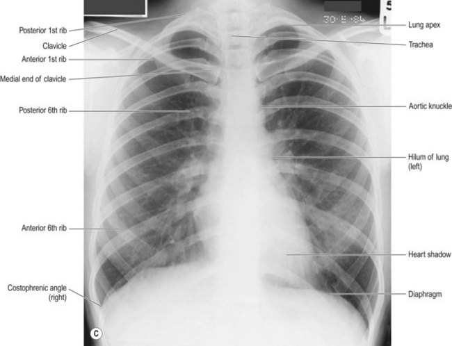 Chest and thoracic contents | Radiology Key