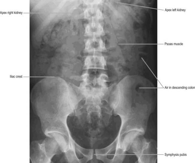 Labeled Abdominal Xray Anatomy - Kub #anatomy #radiology CF5